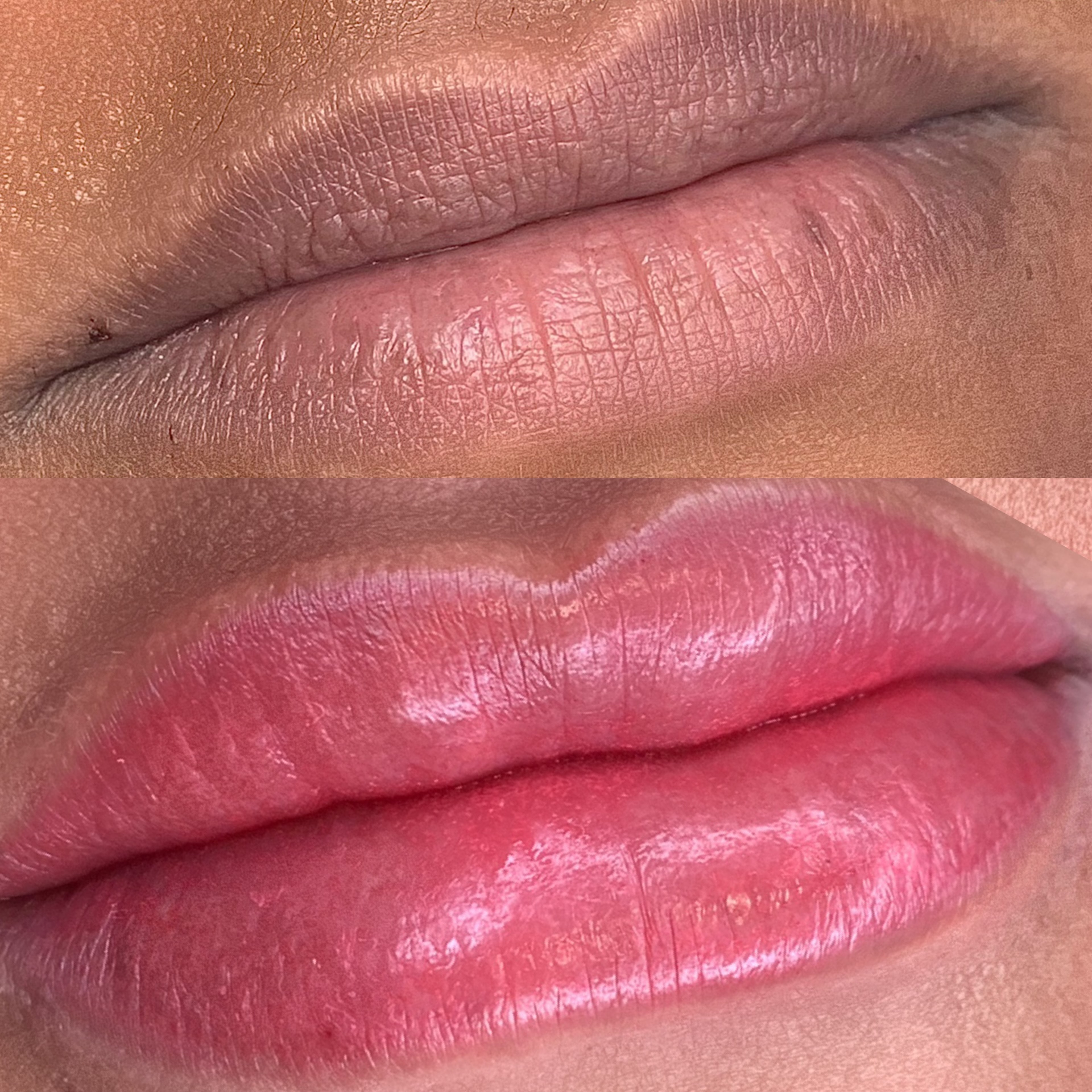 Neutralización de Labios